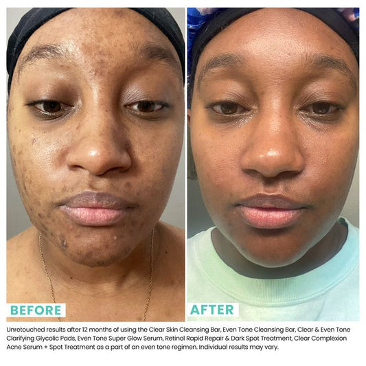 🌿 Benefits of Using Turmeric Soap Daily?